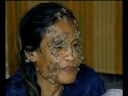 Skin Disease Skin Disease