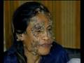 Skin Disease