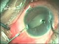 Sudhalkar Eye Hospital: Management of Total PosteriorSynechi