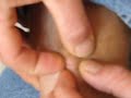 Birth of a Botfly