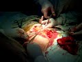 partial omentectomy