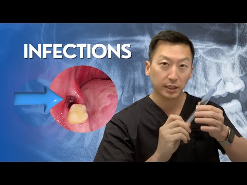 video-linktoworks-Infections after Wisdom Teeth Removal