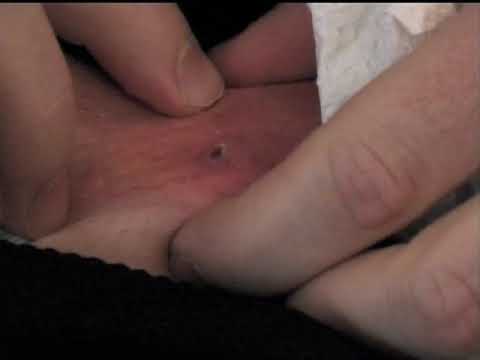gross - THIS IS TERRIBLY DISGUSTING. You've been warned. What he thought was an infected