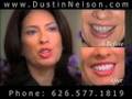 Porcelain Veneers Specialist Los Angeles and Pasadena