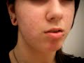 so from my other ear video ive been getting some questions about going to fast and stuff and this is a video to show that my ears are perfectly fine no blowouts. tearing, anything. just watch comment subscribe friend rate anything
