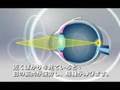 LASIK in Shinbashi 01 LASIK in Shinbashi 01