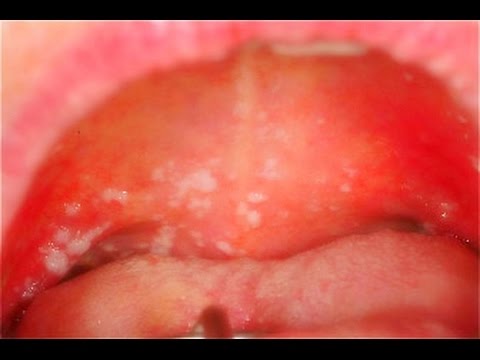 peniciline - http://CureYourYeast.info/ Yeast Infection mouth treatment can be a very easy yeast infection treatment. Yeast infection mouth causes - the reasons why you h...