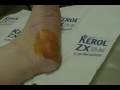 videos de Intro to Cryosurgery