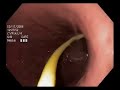 PEG- Percutaneous Endoscopic Gastrostomy PEG- Percutaneous Endoscopic Gastrostomy
