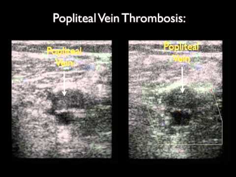 how to perform dvt ultrasound
