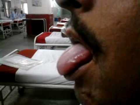 Alcohol withdrawal-tremors