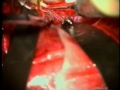 Morcos Video Case 4 - Radial artery graft from CCA-PCA for basilar dolichoectatic aneurysm.mov