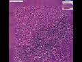 Histopathology Lymph node -- Metastatic undifferentiated lar
