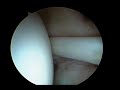 Rotator Cuff Repair