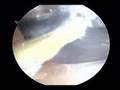 Rotator Cuff Repair
