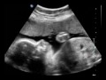 baby waves video 3d sonogram Part 2