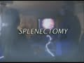 Laparoscopic Splenectomy