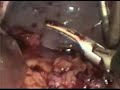 Laparoscopic Splenectomy