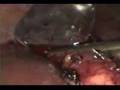 Laparoscopic Splenectomy