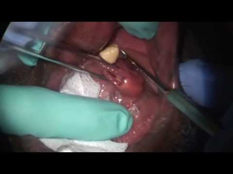 how to unclog bile duct