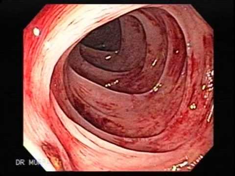 how to cause a gi bleed