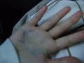 Tina's hand has no circulation..