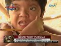  Dalagitang magkakadikit ang mga daliri sa kamay at paa, ipinasuri ng Kapuso Foundation