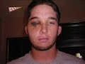 Pitcher Recovers From Line Drive To The Face