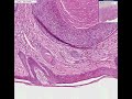 Histopathology Skin, lip--Basal cell carcinoma