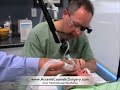 Mixto Laser Fractional Resurfacing Better Than Fraxel Mixto Laser Fractional Resurfacing Better Than Fraxel