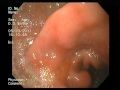 Endoscopia (ahi hernia hietal)