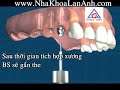 Cay Ghep Implant Nha Khoa
