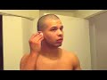 Cauliflower Ear Drainage Cauliflower Ear Drainage