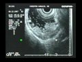 Cancer Of The Rectum In EUS, T3N0 Stage Cancer Of The Rectum In EUS, T3N0 Stage