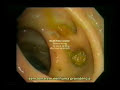 a sa�de depende do estado do intestino. por dr hiromi shinya, que atualmente na cidade de nova york � professor  doutor da faculdade de medicina albert einstein e diretor do centro de colonoscopia do hospital beth israel. d�s de 1969, realiza com sucesso a extirpa��o do p�lipo do intestino grosso sem necessidade de corte abdominal. hoje em dia no mundo inteiro, o m�todo do dr shinya � praticado com sucesso.
informa��es gtfreire@gmail.com