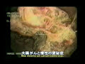 a sa�de depende do estado do intestino. por dr hiromi shinya, que atualmente na cidade de nova york � professor  doutor da faculdade de medicina albert einstein e diretor do centro de colonoscopia do hospital beth israel. d�s de 1969, realiza com sucesso a extirpa��o do p�lipo do intestino grosso sem necessidade de corte abdominal. hoje em dia no mundo inteiro, o m�todo do dr shinya � praticado com sucesso.
informa��es gtfreire@gmail.com