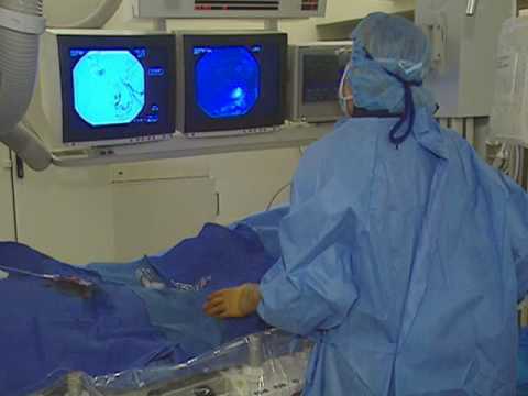 Uterine Fibroid Embolization