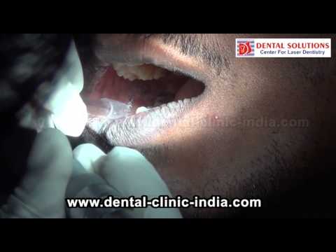 how to cure oral lichen planus