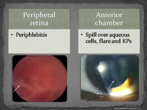how to relieve uveitis