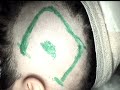 craniotomy for left pariatal intra cerebral masse+ S.wmv