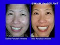 Case studies using Porcelain Veneers