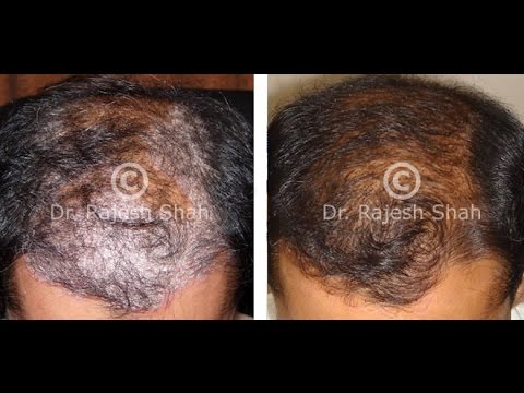 how to recognise eczema