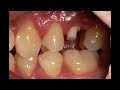 MULTIPLE cases I