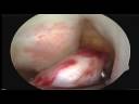 James Key Hole Op on ruptured Anterior Cruciate Ligament