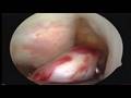videos de James Key Hole Op on ruptured Anterior Cruciate Ligament