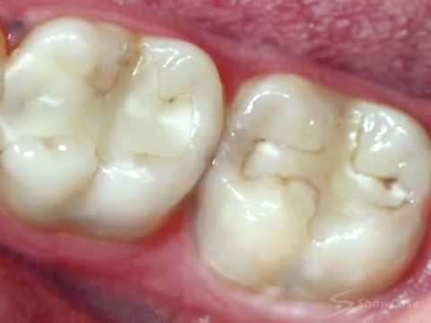 Chipped Front Tooth Filling Fell Out