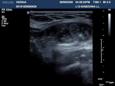 how to exam for inguinal hernia