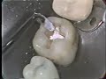 Class I Amalgam Restoration