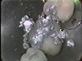 Class I Amalgam Restoration