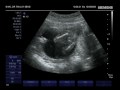 Baby Zachary - 1st Trimester